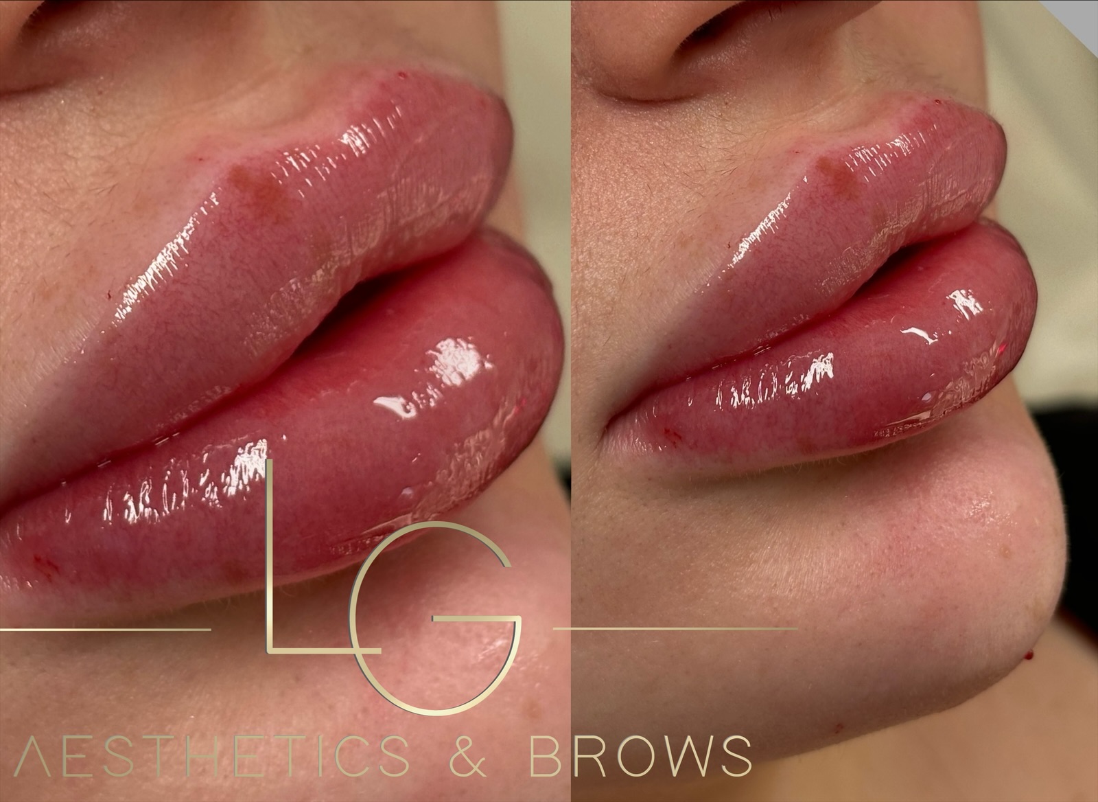 Half-price lip filler (0.5ml) 💋